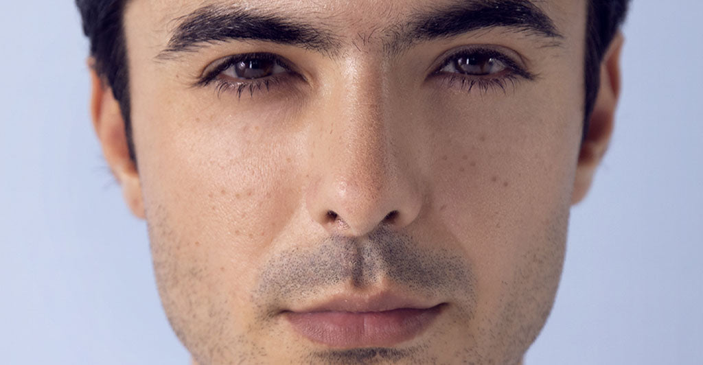 Which Product Is Best To Get Rid Of Acne Scars In Pakistan